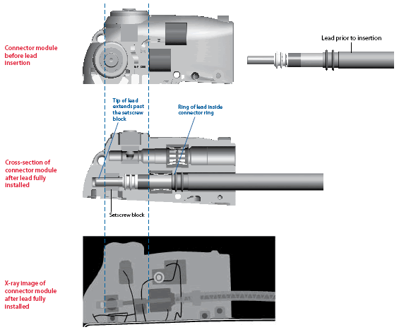 Insertion of the Lead into the Device
